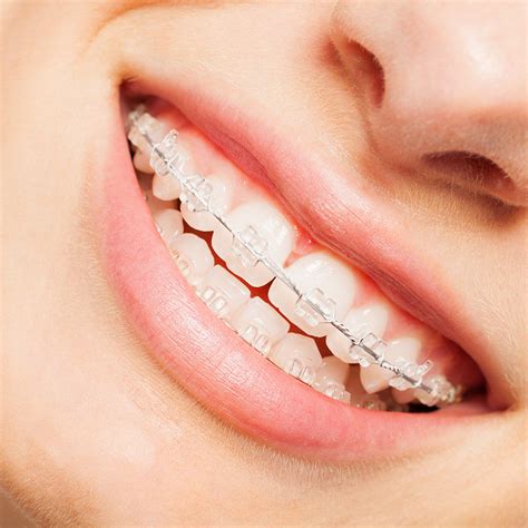 what are the cheapest braces
